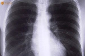 通过X光检查肺部是否存在癌变