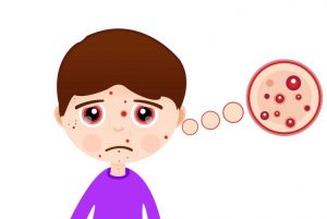男性内分泌失调的轻微症状就是长痘