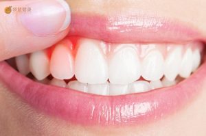 牙龈出血可能是刷牙方式不对，也可能是口腔疾病，要当心！