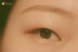单眼皮的人可以开眼角