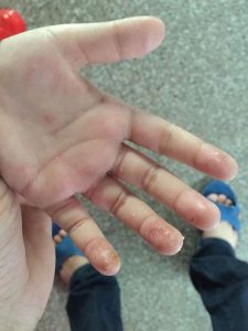 手足口病症状表现